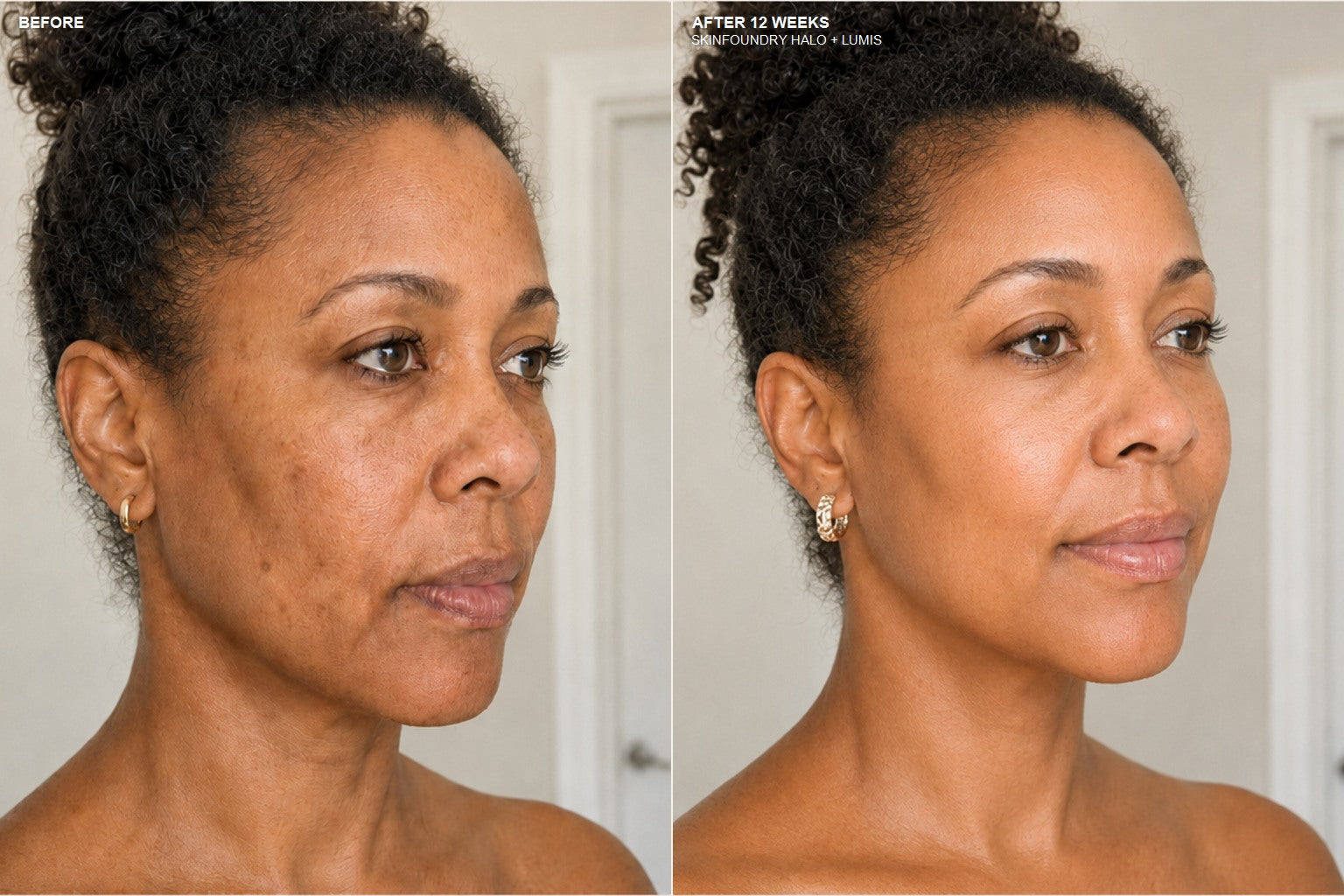 Before and week 12 comparison for Kristin after using SKINFOUNDRY Halo and Lumis
