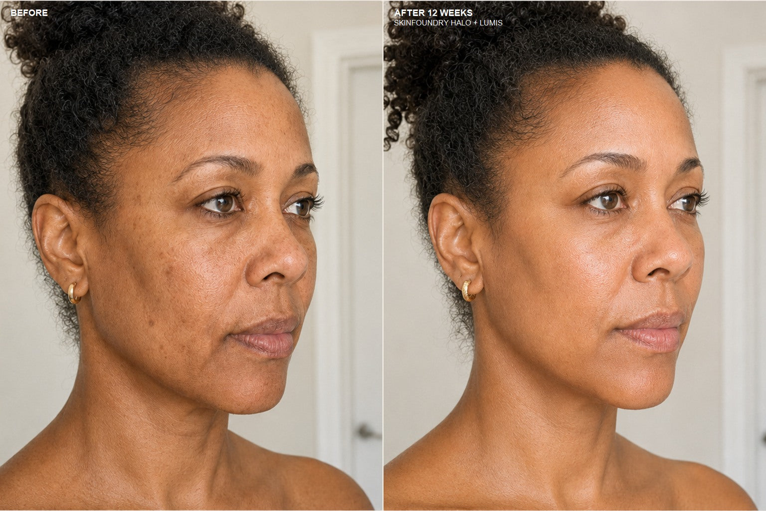 Before and week 12 appearance comparison using SKINFOUNDRY Halo and Lumis